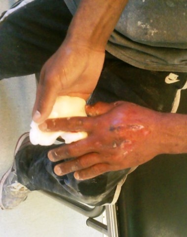 hand_hurt